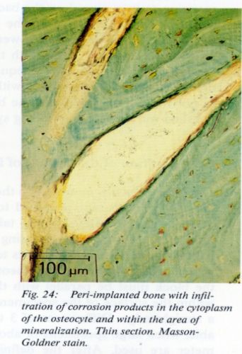 ITB Exakt AMP Medical