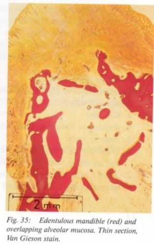 ITB Exakt AMP Medical