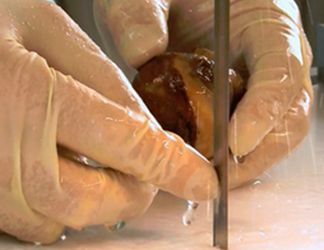 ITB Exakt AMP Medical